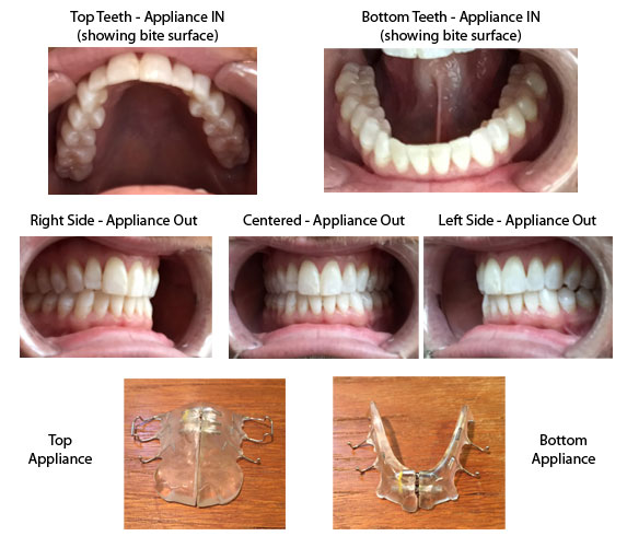 Phase 1 SmileMoore Orthodontics